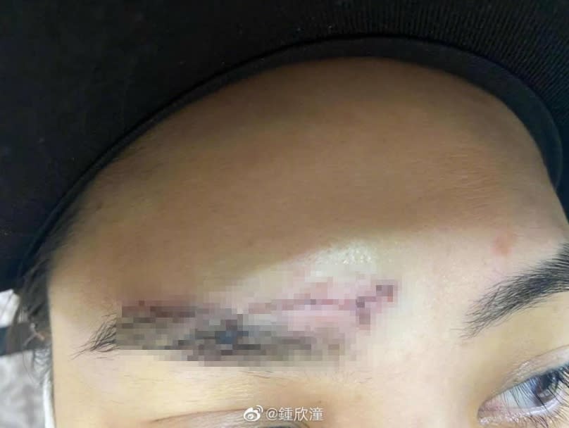 阿嬌9月初意外在飯店跌倒，導致臉上留下6公分的疤痕。（圖／翻攝自阿嬌微博）
