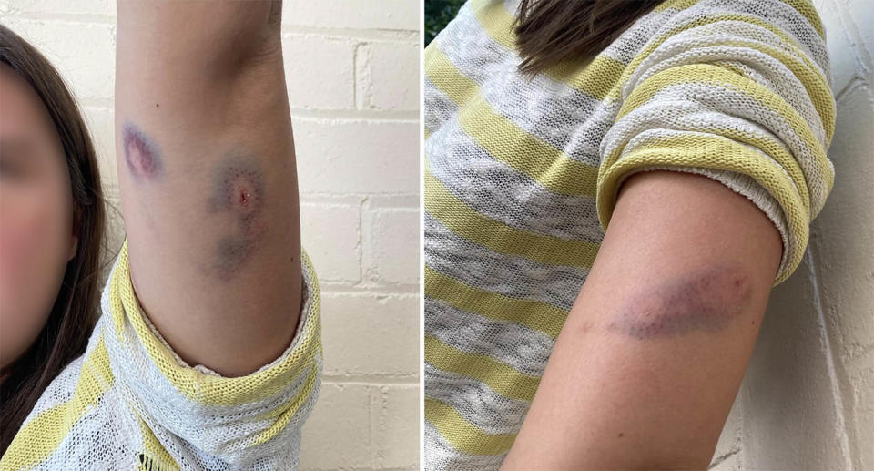 Fiona's left arm with bite wounds and deep bruising after a dog attack.