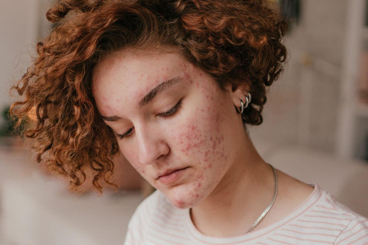 Shoppers Say This Moisturizer Minimizes 'Biblical Plague'-Level Rosacea and Acne Overnight