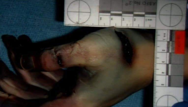 The prosecution contends this photo, shown in court on Jan. 8, 2013, shows Travis Alexander had multiple self-defense wounds to his palms and fingers that indicate he had fought for his life during the knife attack.