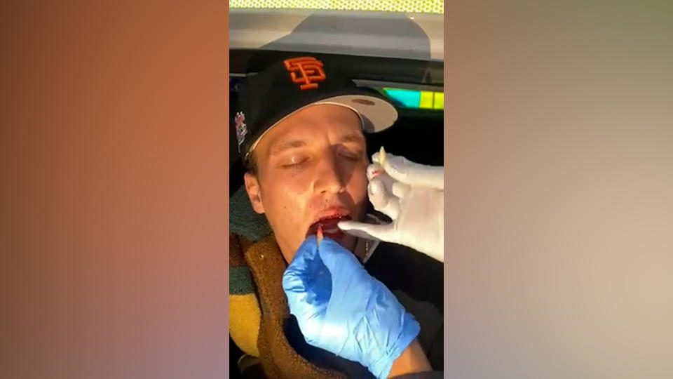 Pro-Palestine protestor having his teeth put back in his mouth.