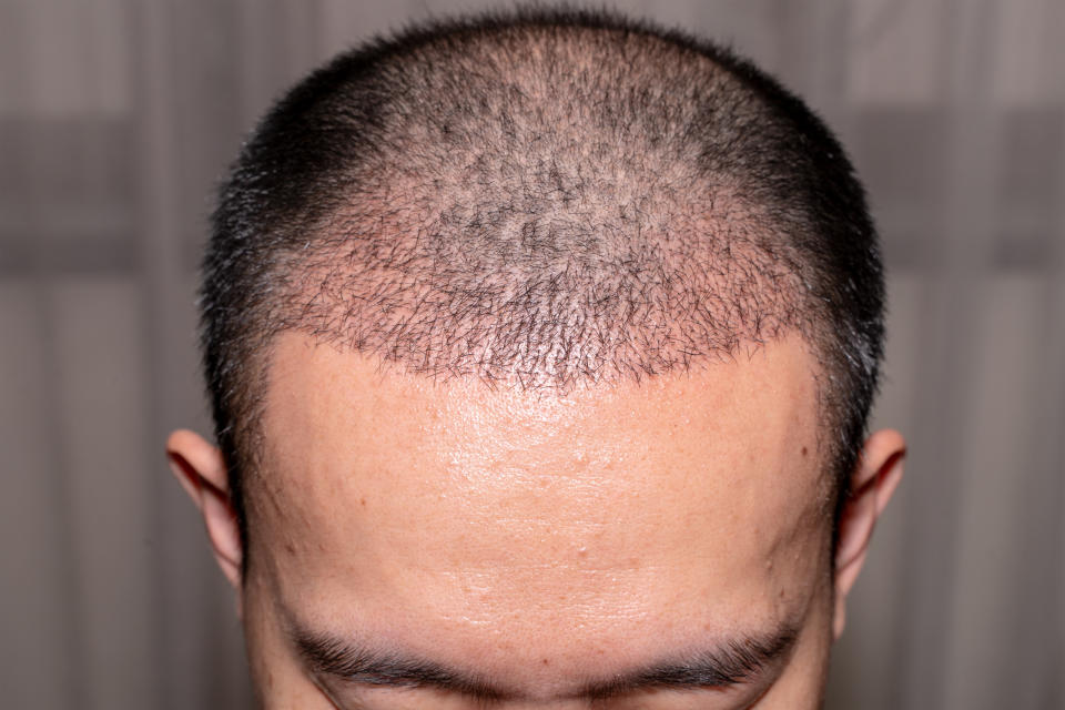 a man's hairline after his hair transplant which is blending in well