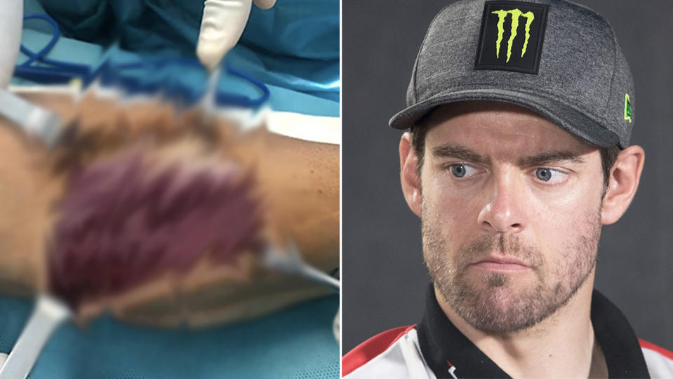 Cal Crutchlow (pictured right) during a media conference and photos from his surgery on his wrist (pictured left).