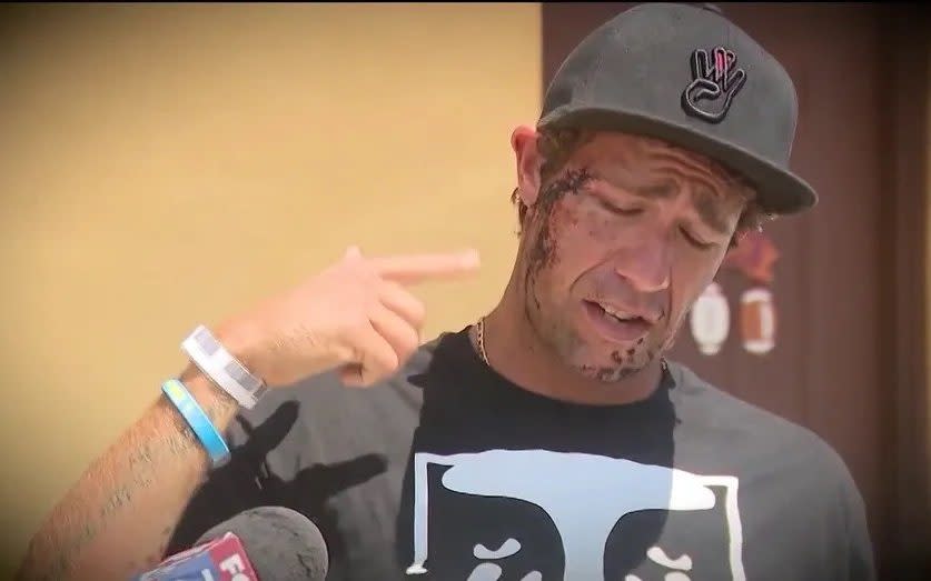 Mark Summerset, a surfer from South Carolina, was bitten on his face. He was lucky to get away with 18 stitches