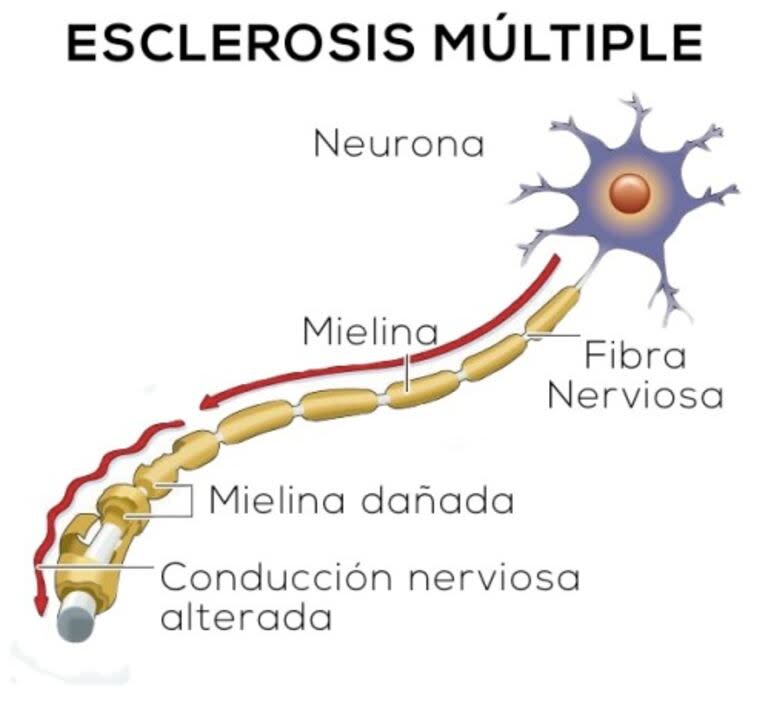 La esclerosis múltiple afecta a más mujeres que varones (Foto: Alejandra Vera/ Prensa de INERE)