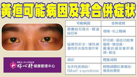 Occurrence of jaundice