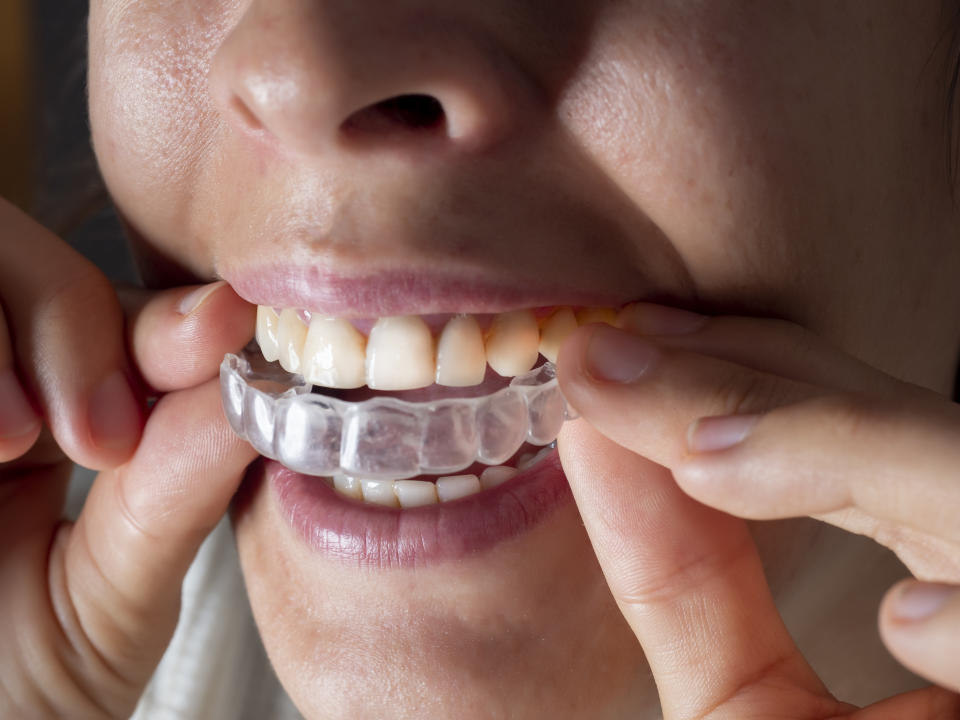 Close-up of a person inserting a clear dental aligner over their teeth. The image highlights dental care and orthodontic devices
