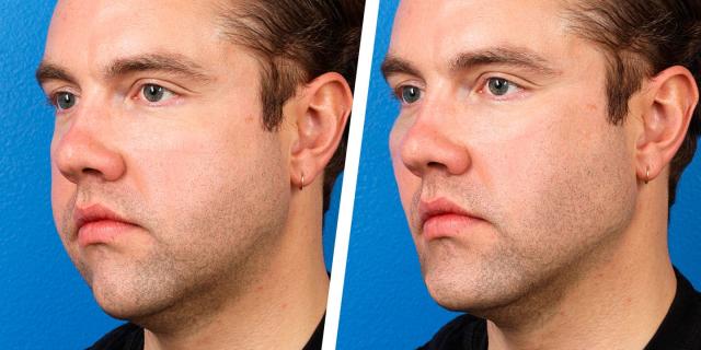 How ANYBODY Can Get a Chiseled Face & Strong Jawline (THE ONLY WAY TO LOSE  FACE FAT!) 