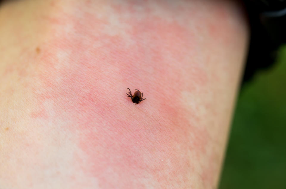 Irritation from the bite. Redness on the skin from a tick bite. A dangerous tick bite. Close-up.