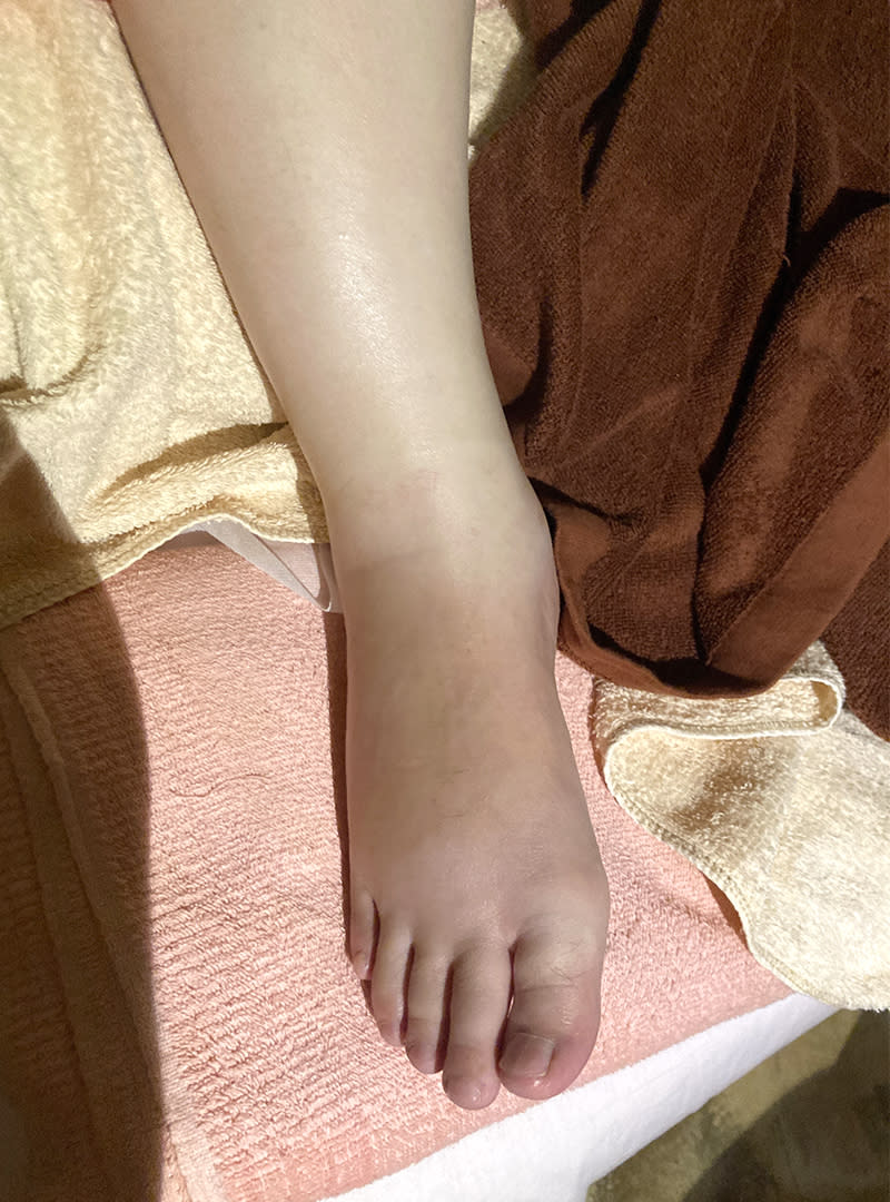 芳香療程後孕媽咪腳踝水腫大幅改善圖示案例