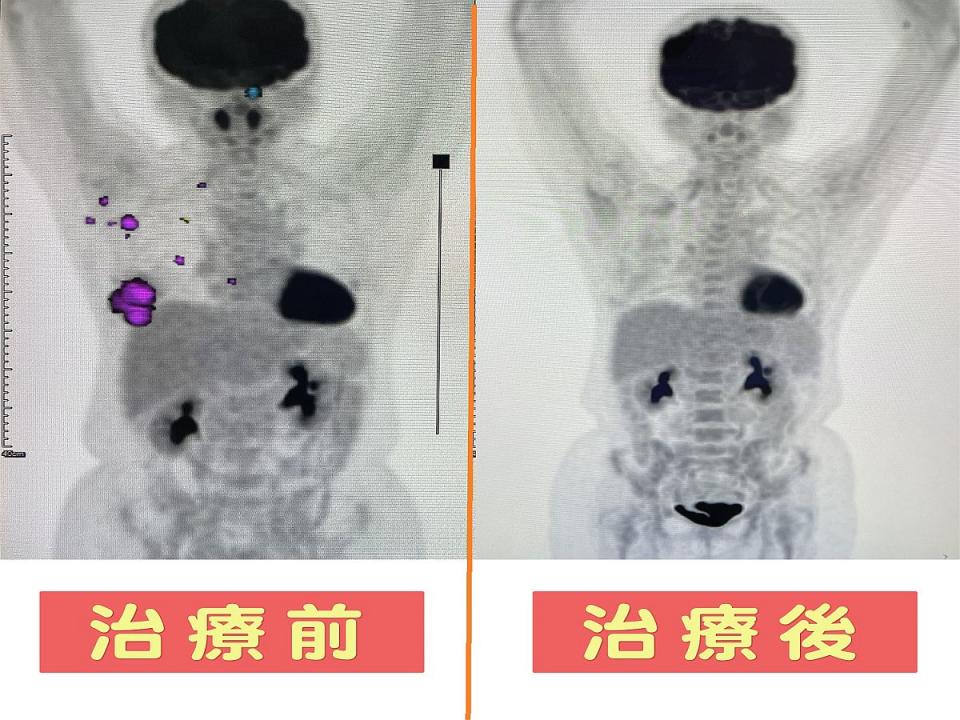 醫師說，晚期的HER2乳癌，常見轉移至腦部、骨骼、肺部及肝臟，早期發現治療是預防轉移的關鍵。（圖：烏日林新醫院提供）