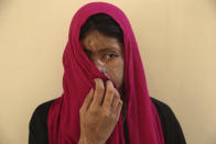 <p>Acid attack survivor Sana Naz poses for a photo during a gathering at an NGO office ahead of International Women’s Day in Karachi, Pakistan, Wednesday, March 8, 2017. (Photo: Shakil Adil/AP) </p>