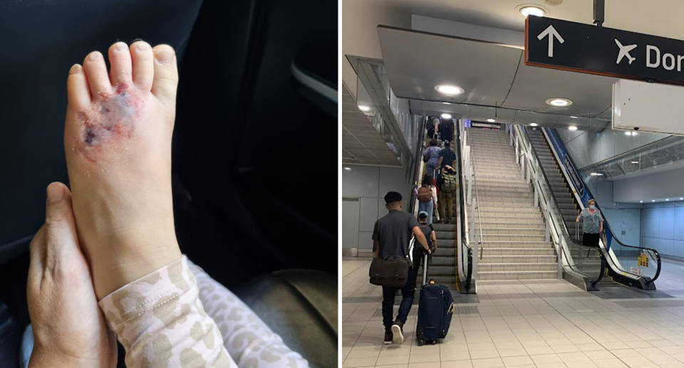 A photo of the bruised foot of the four-year-old whose Croc got stuck in the side of an escalator going down to the train at Sydney Domestic Airport.