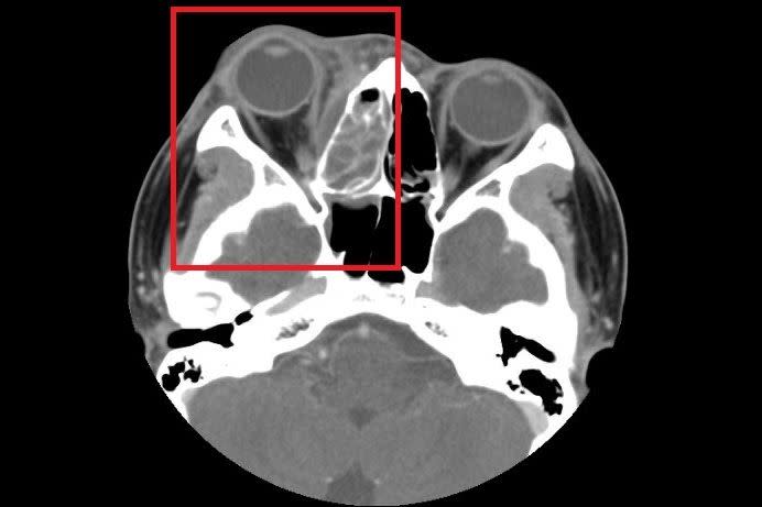 電腦斷層影像顯示，膿瘍壓迫到眼部肌肉（紅框處），導致眼球凸出、活動受阻。（圖／台北慈濟醫院提供）