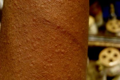 stress hives on dark skin