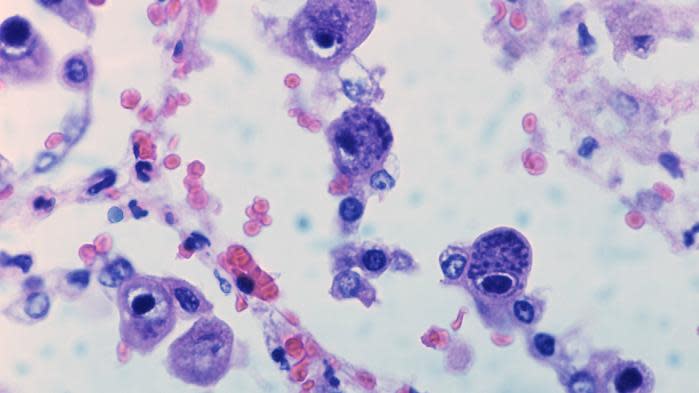 Imagen de tejidos humanos infectados por Citomegalovirus. Crédito: <span class="asset-item-link"> <span class="asset-item-author">Franceinfo</span> </span>