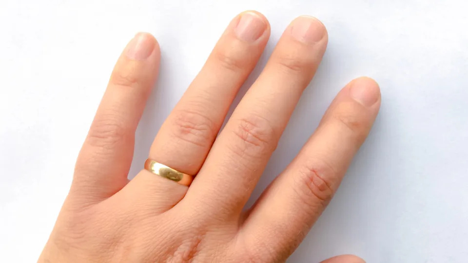 A swollen hand, one of the early warning signs of psoriatic arthritis, with a gold wedding band