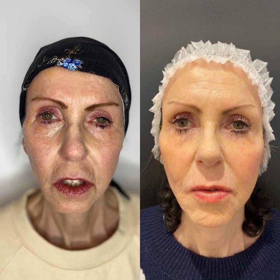 Summer pictured here before and after her dermal fillers in December 2020 (Collect/PA Real Life).