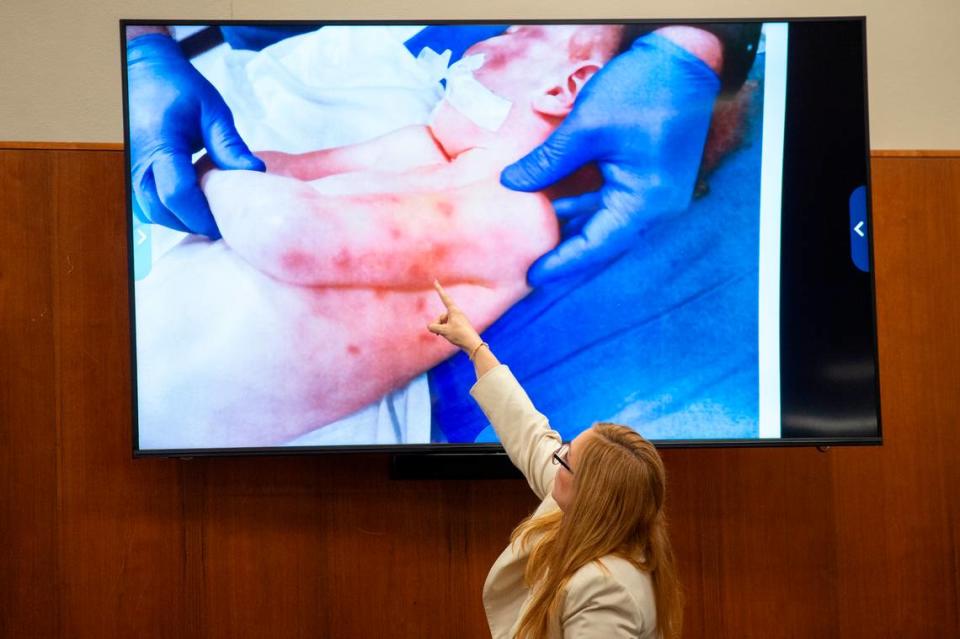 Dr. Leanne Lee points out bruising on a photo of Hayden Bataille’s body during her expert witness testimony in Joseph David Heard’s trial for capital murder in the death of Hayden Bataille in Harrison County Circuit Court in Biloxi on Wednesday, May 8, 2024.
