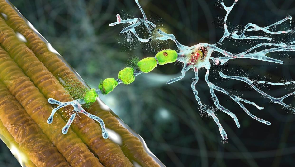 file lf uz <a href="https://www.shutterstock.com/es/image-illustration/degradation-motor-neurons-conceptual-3d-illustration-1969483819" rel="nofollow noopener" target="_blank" data-ylk="slk:Kateryna Kon / Shutterstock;elm:context_link;itc:0;sec:content-canvas" class="link ">Kateryna Kon / Shutterstock</a>