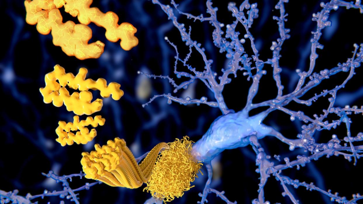  Medical illustration of a neuron, in blue, in the background being surrounded by a plaque of amyloid-beta protein, in yellow with the illustration visualizing how the proteins join together . 