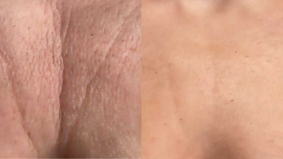 Before and after pictures of a decolletage 