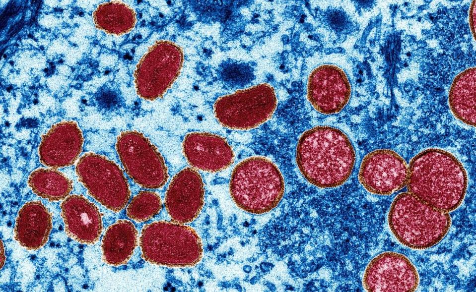 Una imagen de microscopio electrónico muestra partículas del virus de la viruela del mono de una muestra de piel humana del brote de 2003.