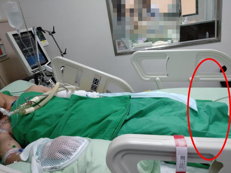 陳男自5月24日進行截肢手術後，至今仍在加護病房。民眾提供