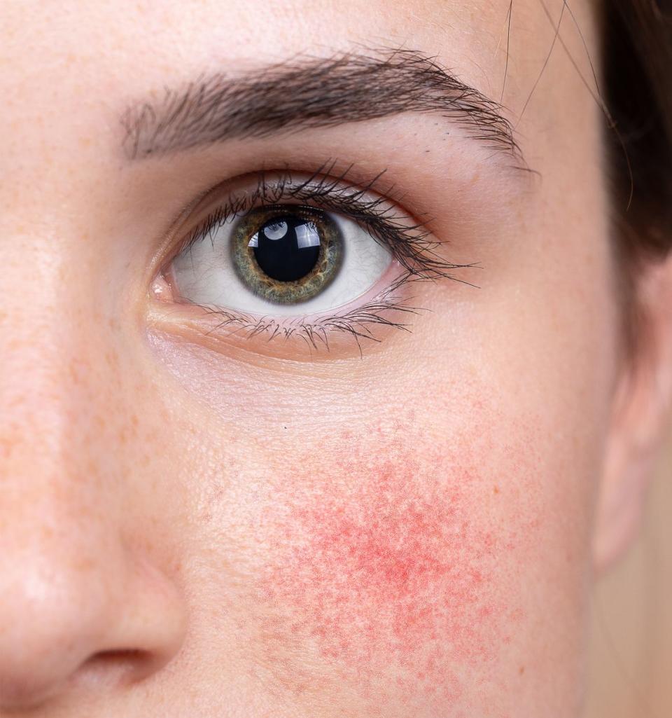 close up of a woman's face with red flushed or rashy cheeks