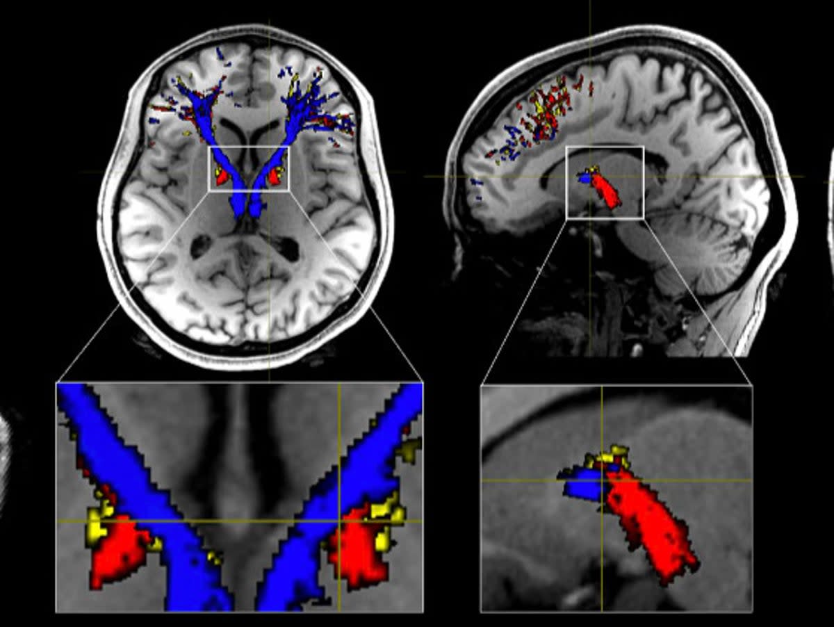 Addicts’ brains contain less white matter than people who do not consume the class A substances, say experts (SWNS)