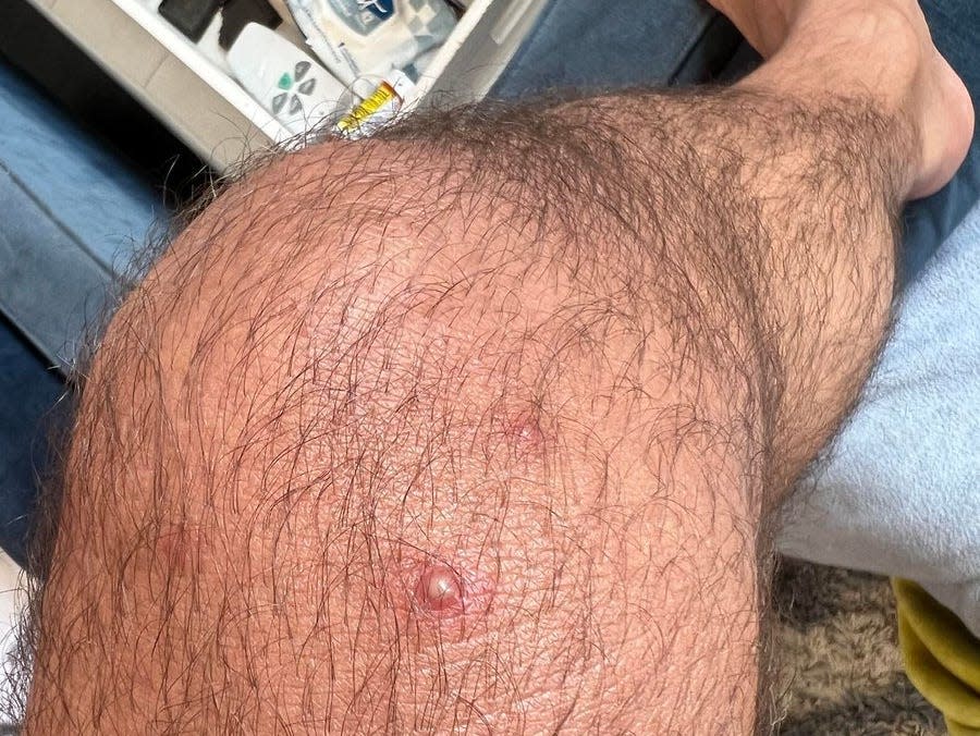 A lesion is shown on Steele's leg.