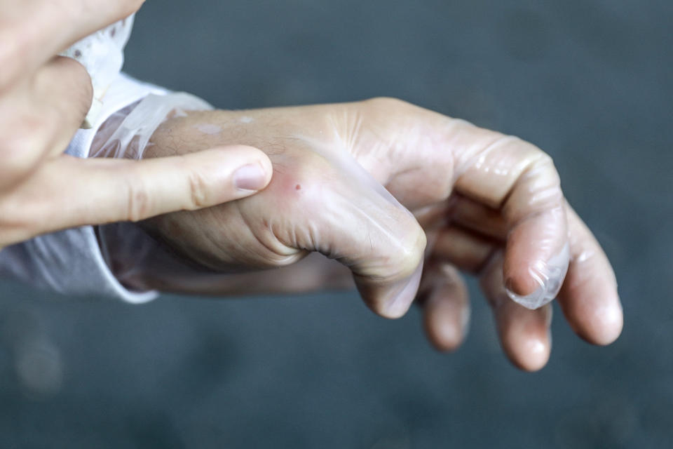 Luke Brown points to a monkeypox lesion on the knuckle of his thumb.
 (Benjamin Ryan for NBC News)