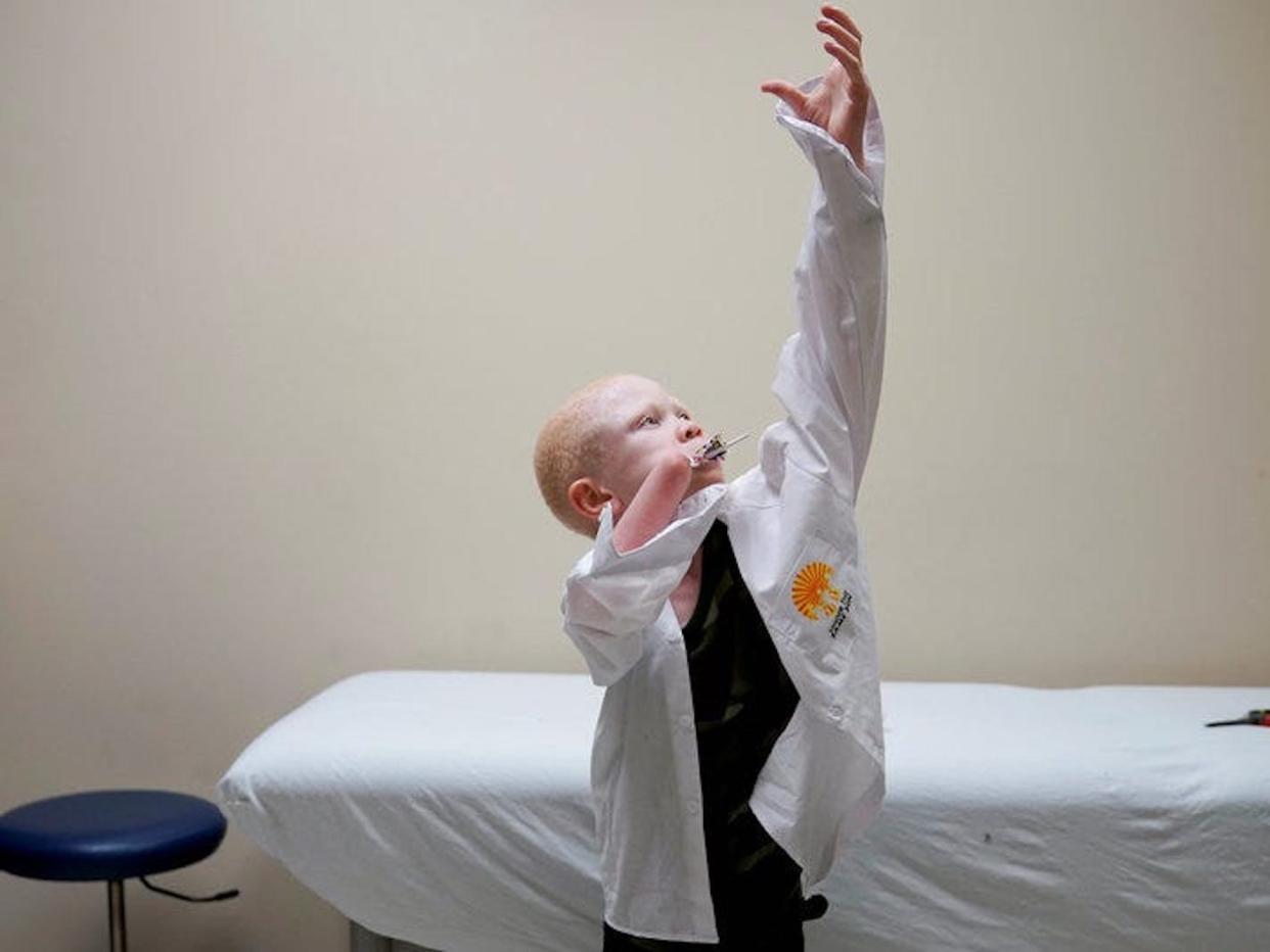 Albinism in Africa. Boy who had an arm chopped off in a witchcraft-driven attack. Pennsylvania. May 2017