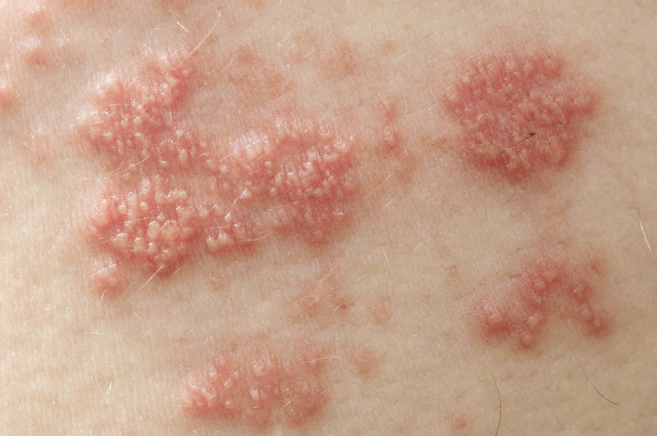 Shingles (Getty Images)