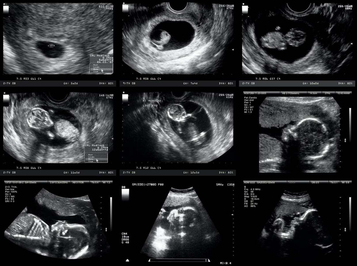 <span class="caption">Science can observe these various phases of fetal development but cannot determine when human life begins.</span> <span class="attribution"><a class="link " href="https://www.gettyimages.com/detail/photo/pregnancy-ultrasound-royalty-free-image/168415756" rel="nofollow noopener" target="_blank" data-ylk="slk:UrsaHoogle/E+ via Getty Images;elm:context_link;itc:0;sec:content-canvas">UrsaHoogle/E+ via Getty Images</a></span>