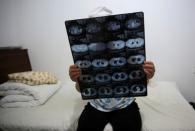 Huang shows her CT scan film in her room at the accommodation where patients and their family members stay while seeking medical treatments in Beijing, China, June 22, 2016. REUTERS/Kim Kyung-Hoon