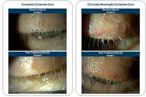 Saturn-1 patients' collarettes at baseline (Day 0, Grade 4) and post treatment (Day 43, Grade 0, left) and (Day 43, Grade 1, right). Images demonstrate results which we believe are representative of favorable treatment with TP-03 for patients participating in the Saturn-1 trial. Other patients may experience different or less favorable results.