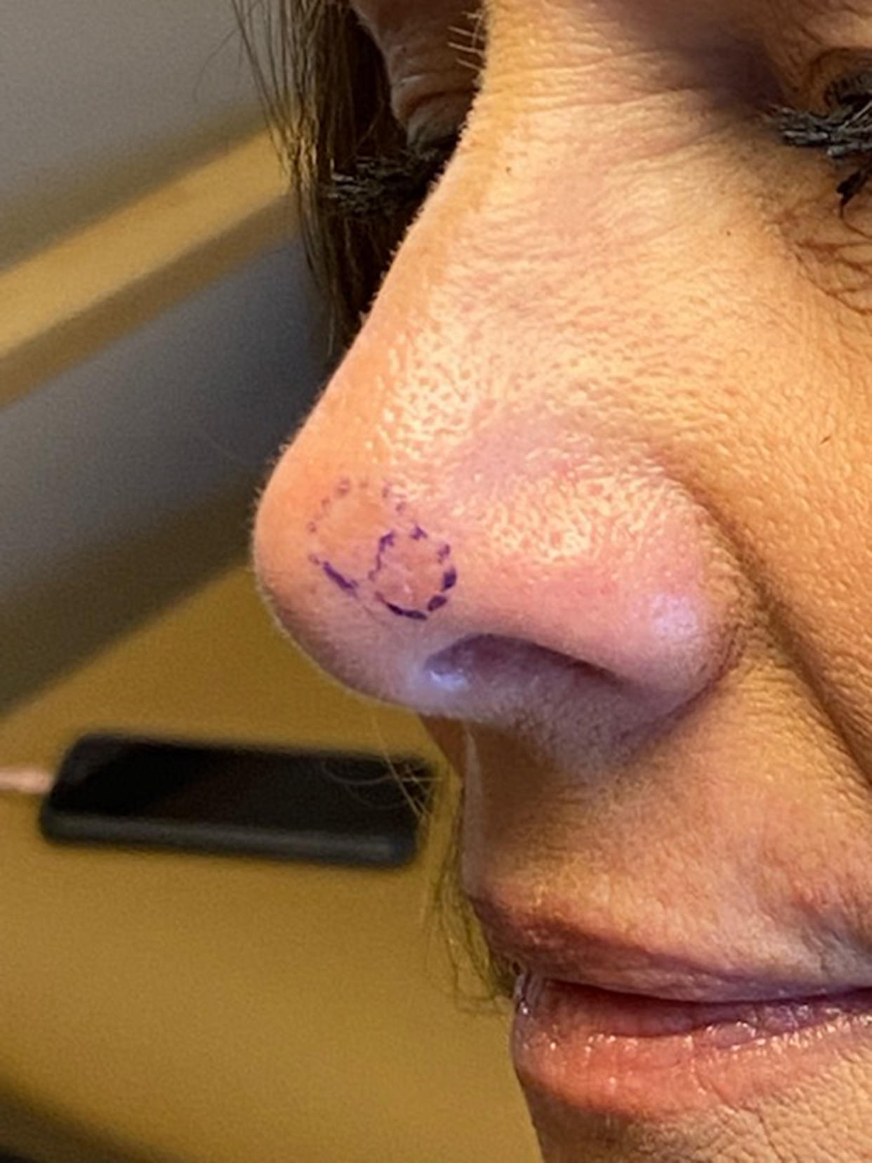 This photo shows the suspicious spot on Sabine's nose before surgery. (Courtesy Kathy Sabine)