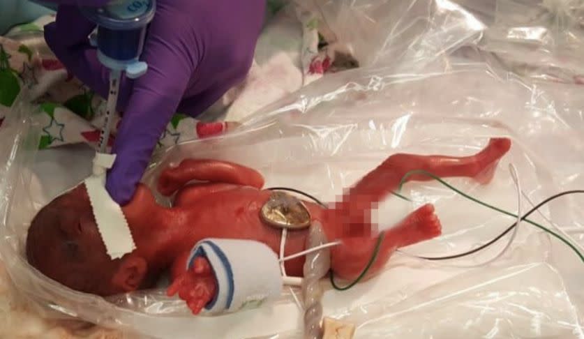 The baby has been dubbed a 'miracle' for surviving when she was born so early