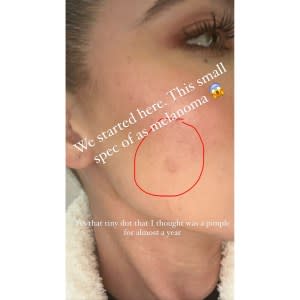 Khloe Kardashian Shares Before and After Photos of Her Cheek Post-Cancer