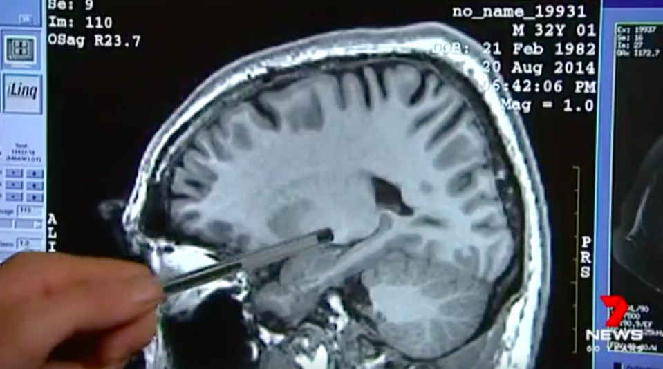 An MRI revealed that Leah had a condition known as transient global amnesia. Source: 7News