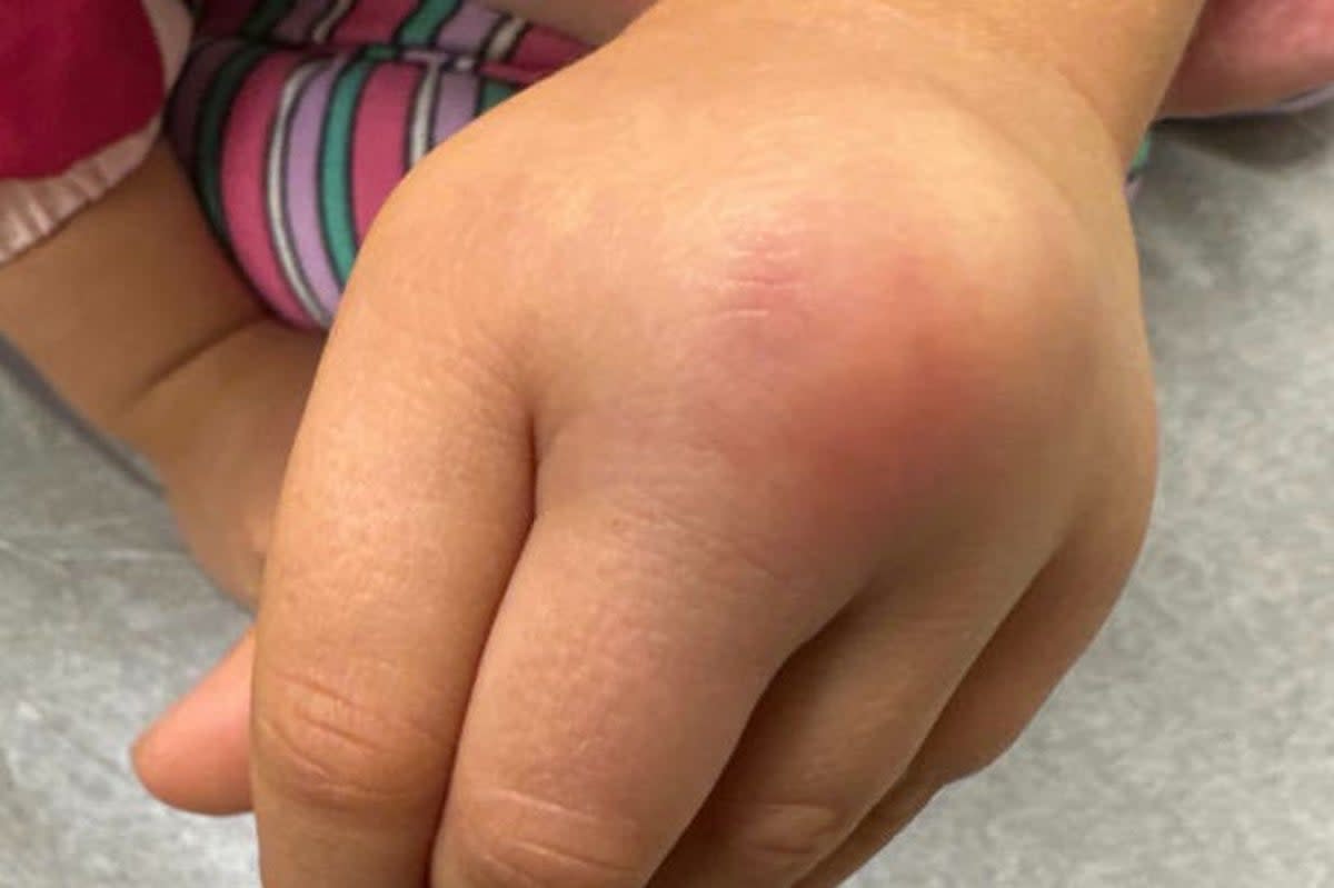 A ‘bump' on the toddler’s hand slowly grew and then developed a reddish-bluish hue (Dr Jordan Mah, Stanford University School of Medicine / SWNS)