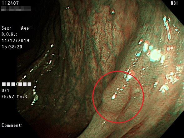 大腸鏡對於早期發現大腸癌來說，有非常顯著的效果。圖中紅圈處為「管狀腺瘤」（息肉）。
