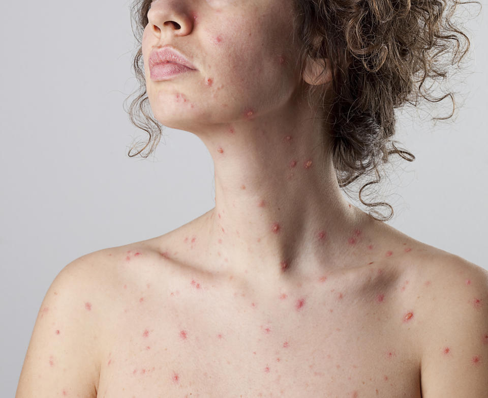 Adults can suffer from more severe chickenpox symptoms, including more spots. (Getty Images)