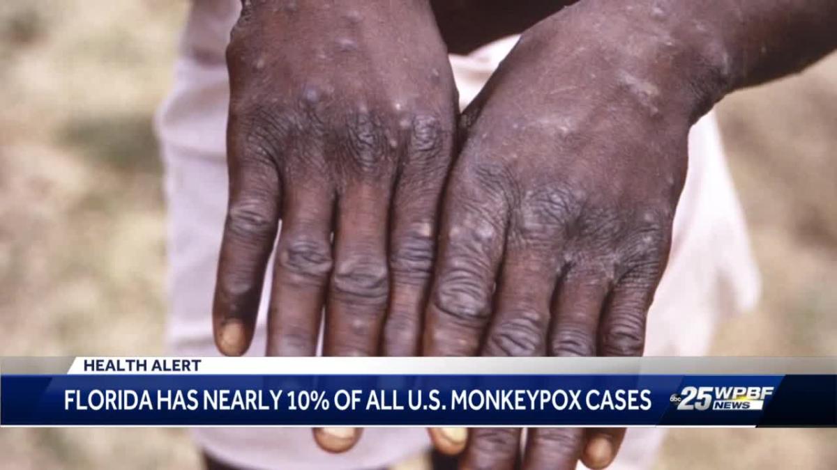 Florida has nearly 10 of all Monkeypox cases