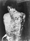 Keloids cover the back of a survivor of the Nagasaki atomic bomb. Keloids are dense, fibrous growths that grow over scar tissue. (Photo: Corbis via Getty Images)