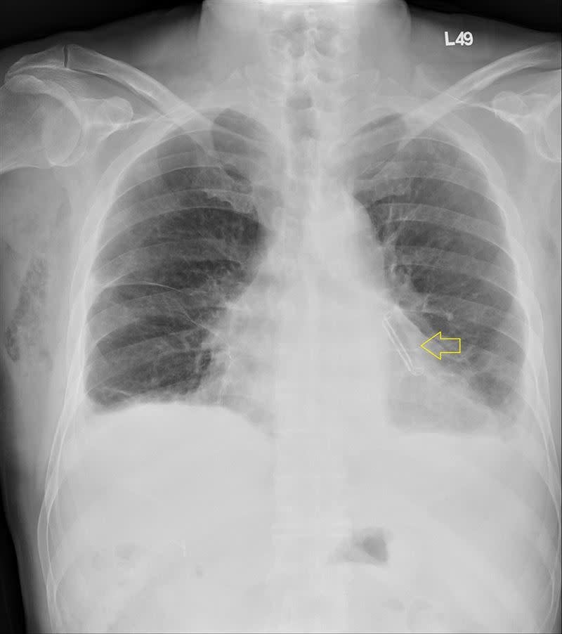 術後X光，心耳已被夾閉（箭頭處）（圖／台北慈院提供）