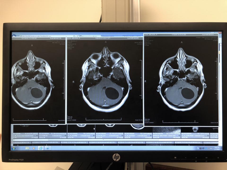 An image of Melissa Lesh's MRI scan