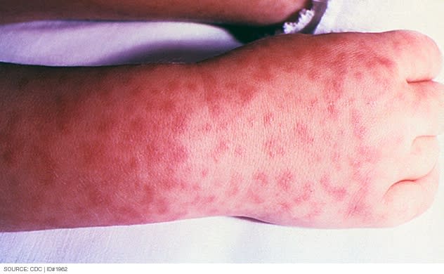 Rocky Mountain spotted fever rash. Source: Mayo Clinic 