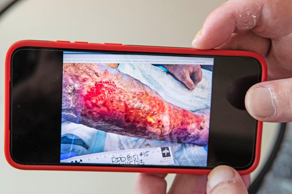 Anthony shows a photo of his injured arm during an interview at his mother's home in Lewes, Thursday, Sept. 7, 2023. Anthony, who has struggled with addiction for the last nearly 15 years, recently almost lost both arms due to xylazine, known as "tranq dope."